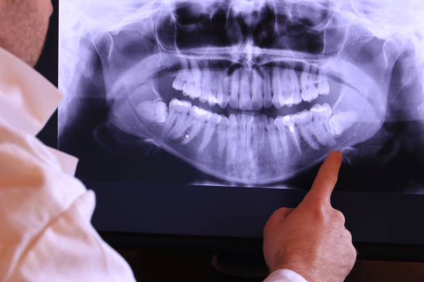 Best Emergency Root Canal Treatment in Butler, OH