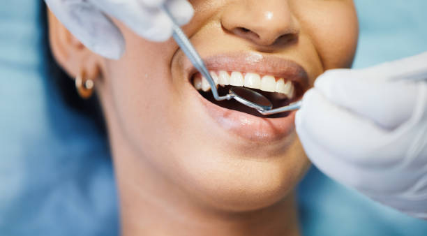 Best Emergency Tooth Extraction in Butler, OH